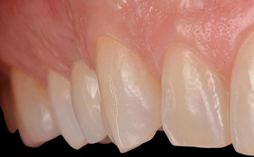Implante dental premolar, Glosario BQDC