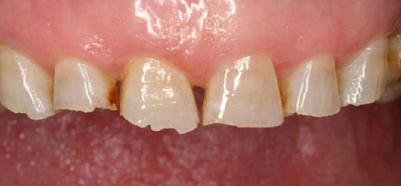 Atrición dental superior
