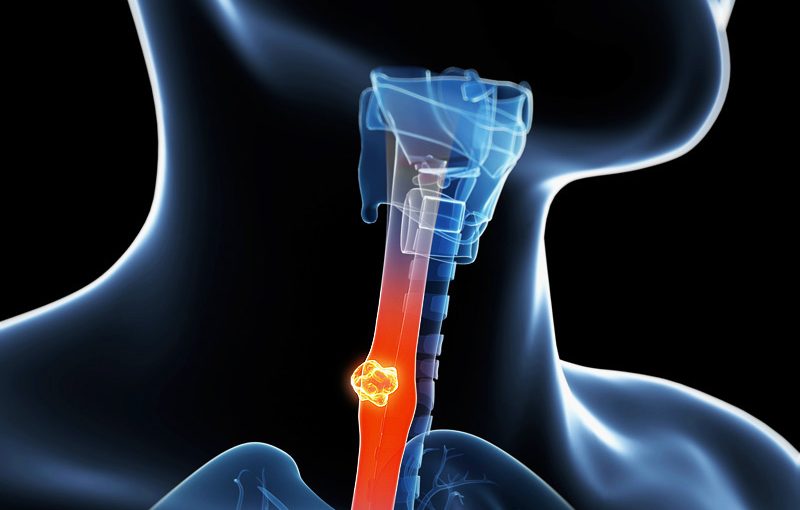 Cáncer de esófago. Medidas de prevención y síntomas