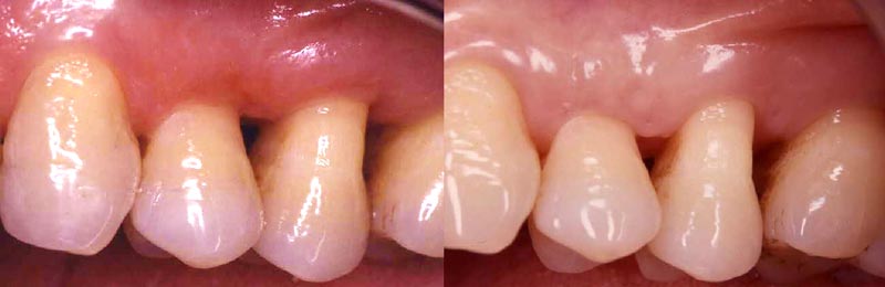 Cirugía periodontal para eliminación de bolsas periodontales