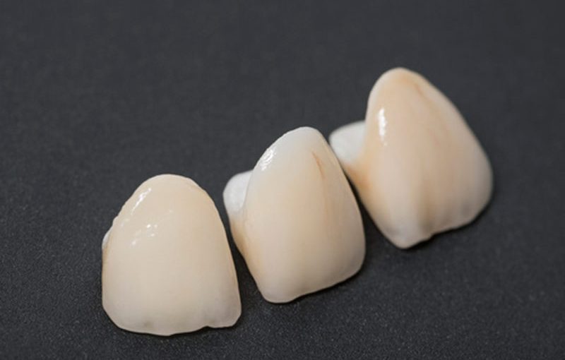 coronas-dentales