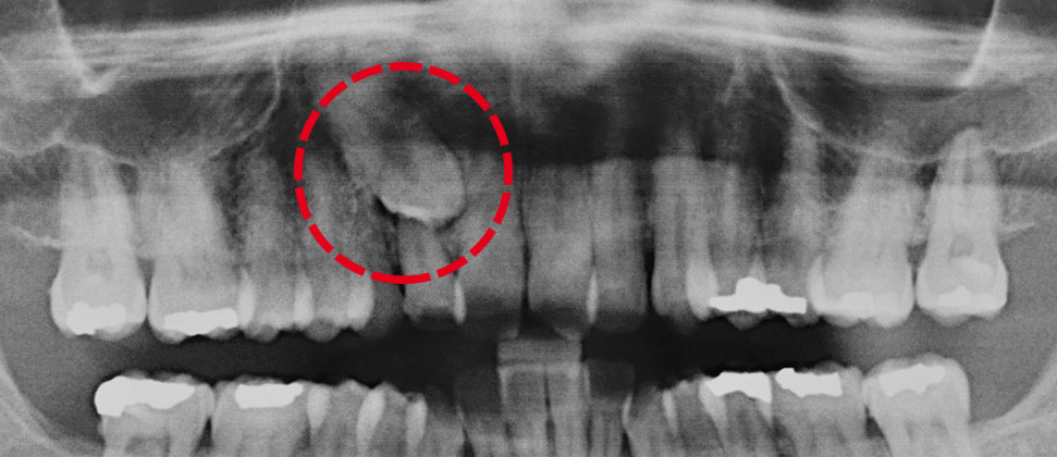 Caso clínico diente impactado: Diagnóstico