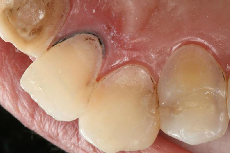 Erosión dental interior