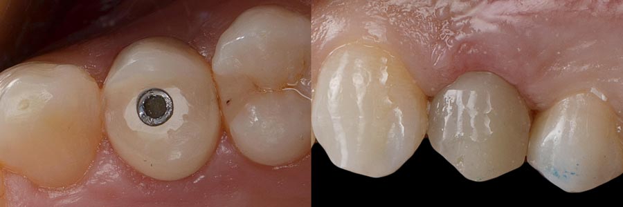 Corona provisional en Implante dental