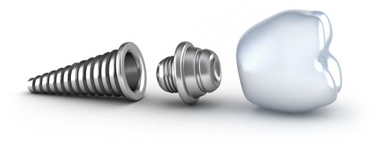 Las ventajas de los implantes dentales