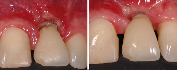 Mucositis antes y después