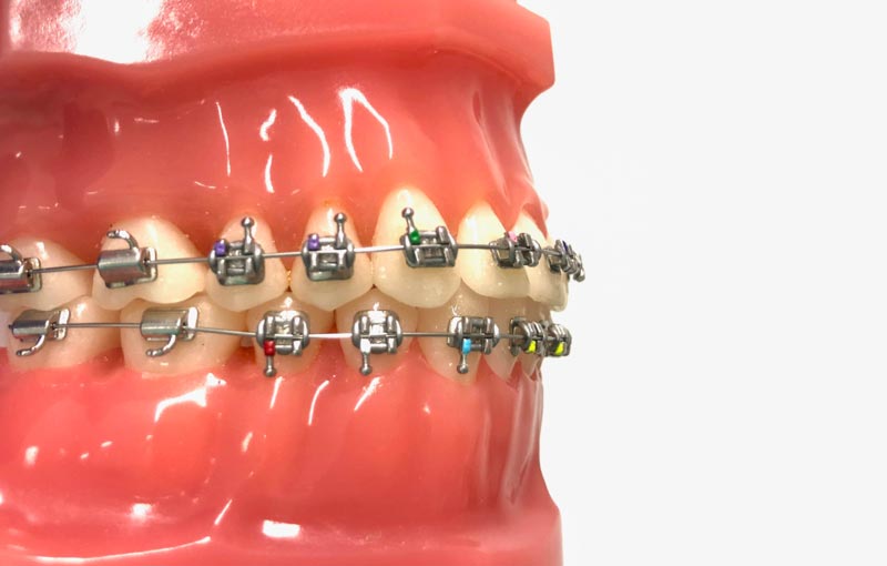 Brackets de autoligado características de esta ortodoncia