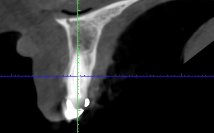 Radiografía periápice 2