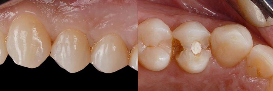 Endodoncia de premolares
