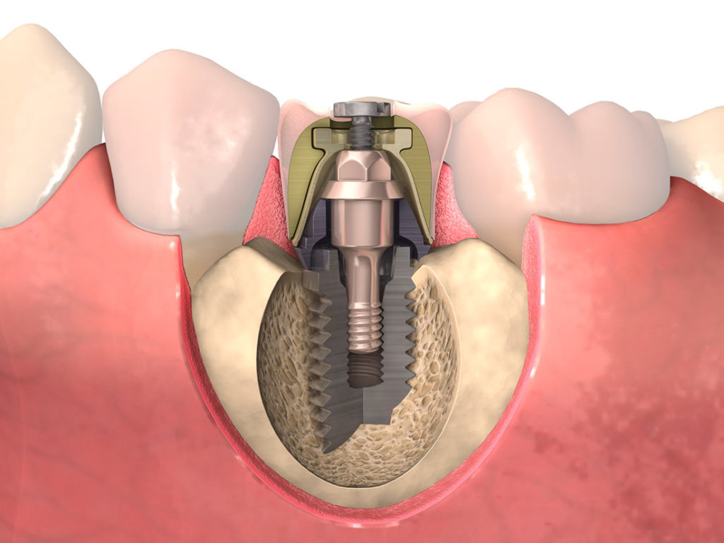 Procedimiento de implantes dentales