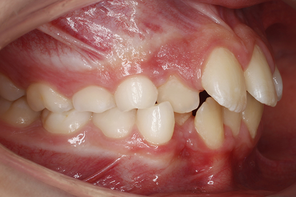 Protrusión dentaria - antes