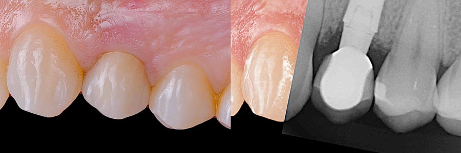 Resultado final implante dental