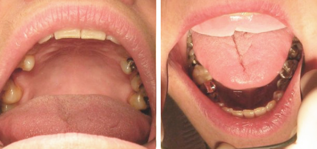 Síndrome de la boca ardiente caso clínico BQDC