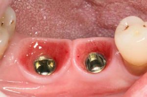 Raíz del implante dental, glosario BQDC